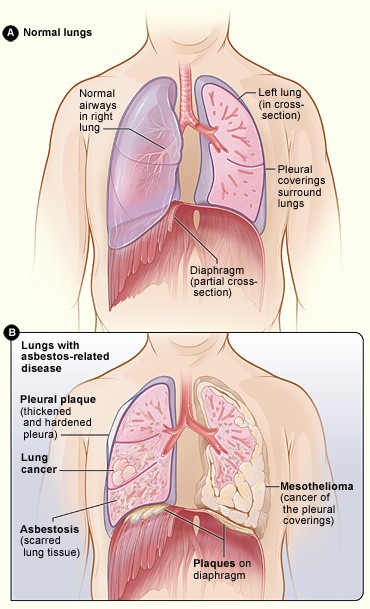 asbestos-lungs